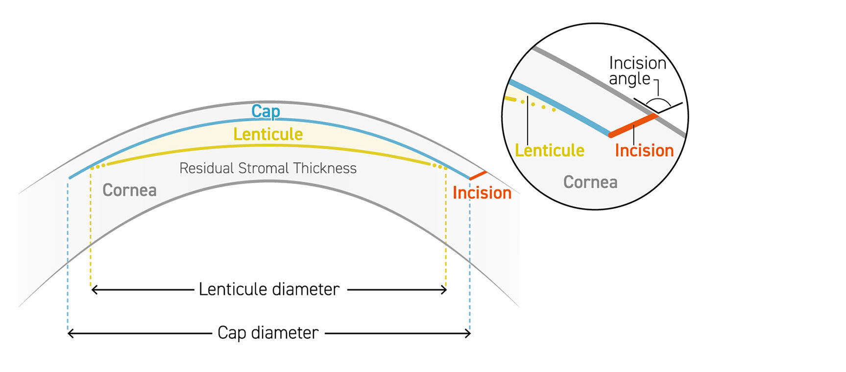 SmartSight – minimally invasive lenticule extraction