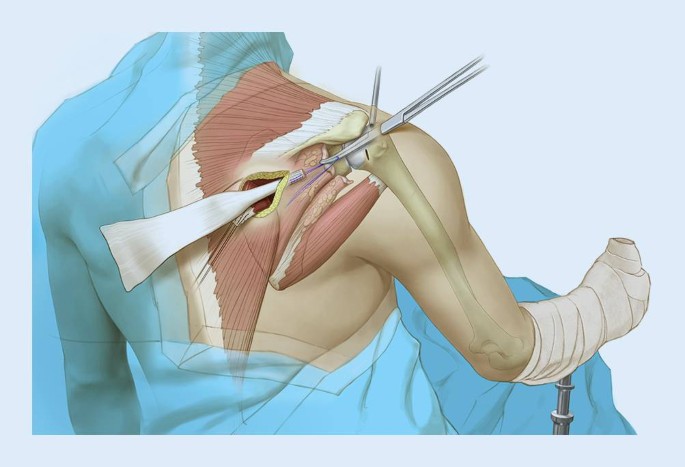 Lower Trapezius Transfer